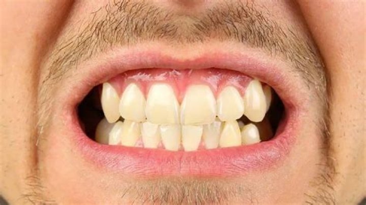 ¿Aprietas los dientes? Estos son los posibles motivos